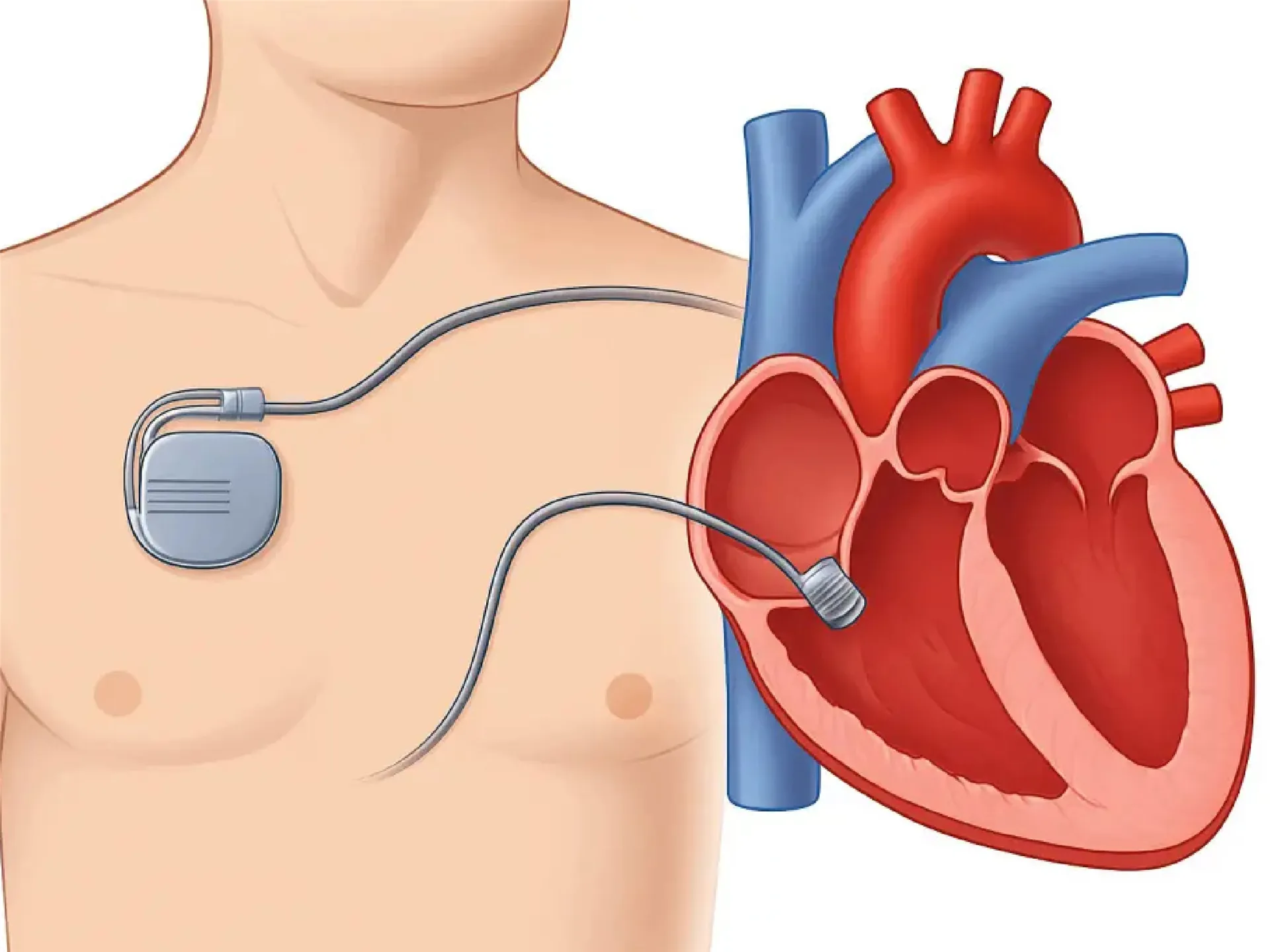 Removal Of Implanted Cardiac Pacemaker Electrodes