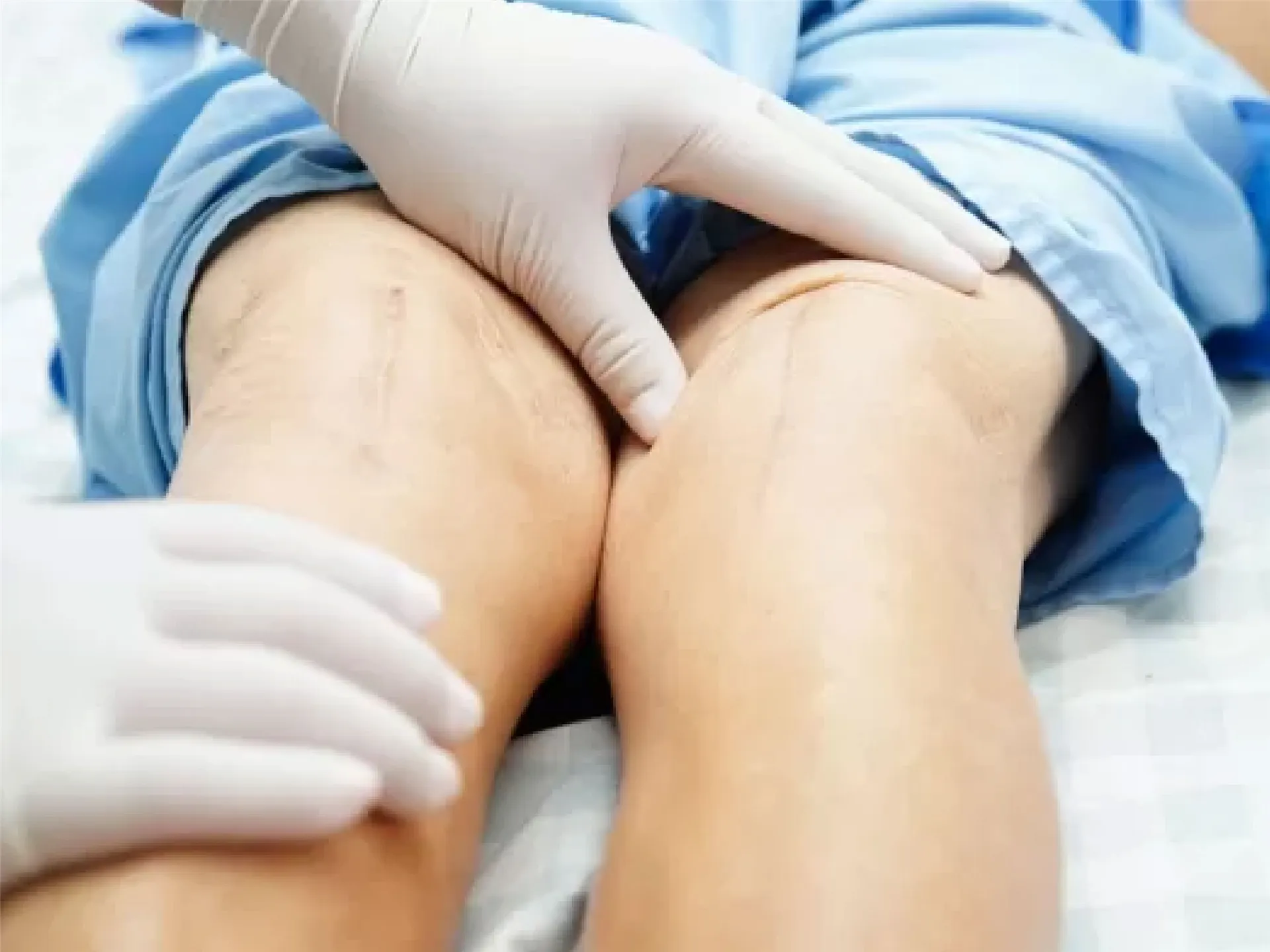 Treatment Of Peripheral Artery/Vein Diseases