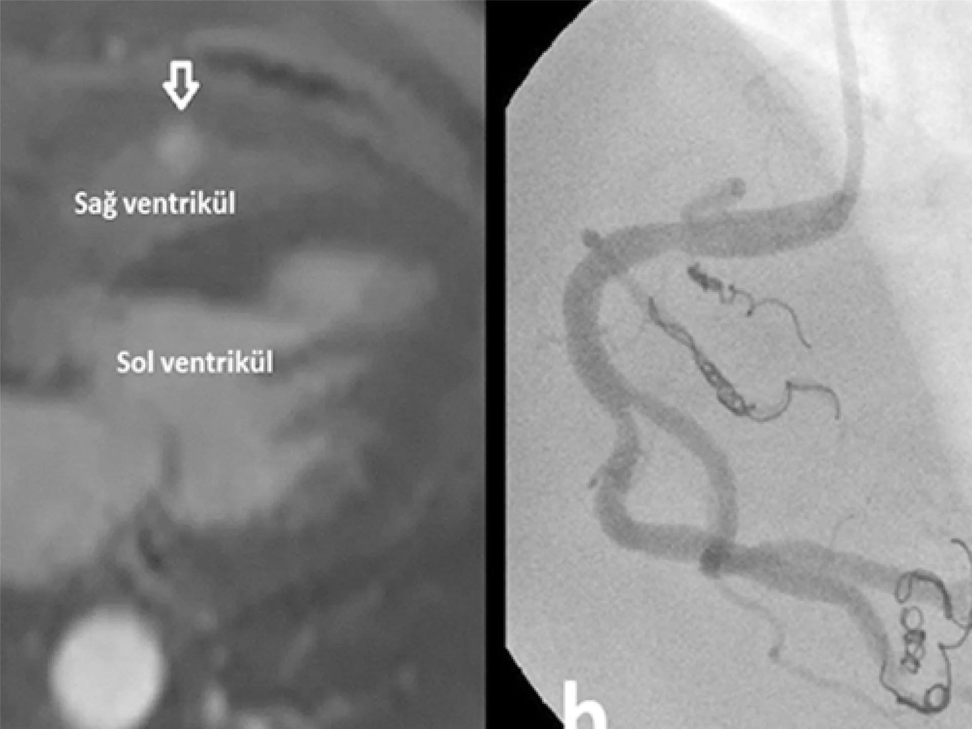 Coronary And Peripheral Vascular Fistula And Embolization Treatments