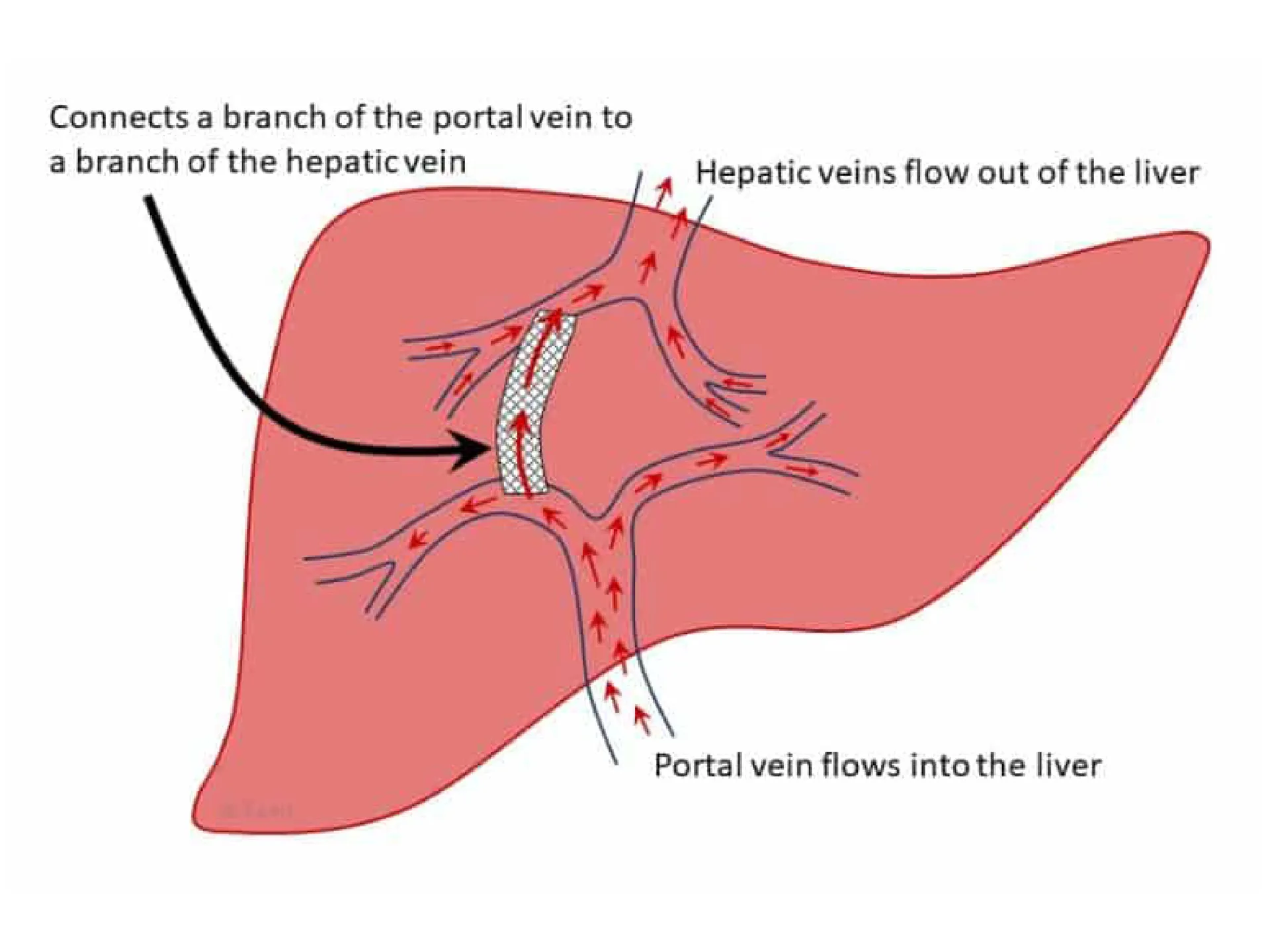 Transhepatic Portosystemic Shant (TIPS) Treatments