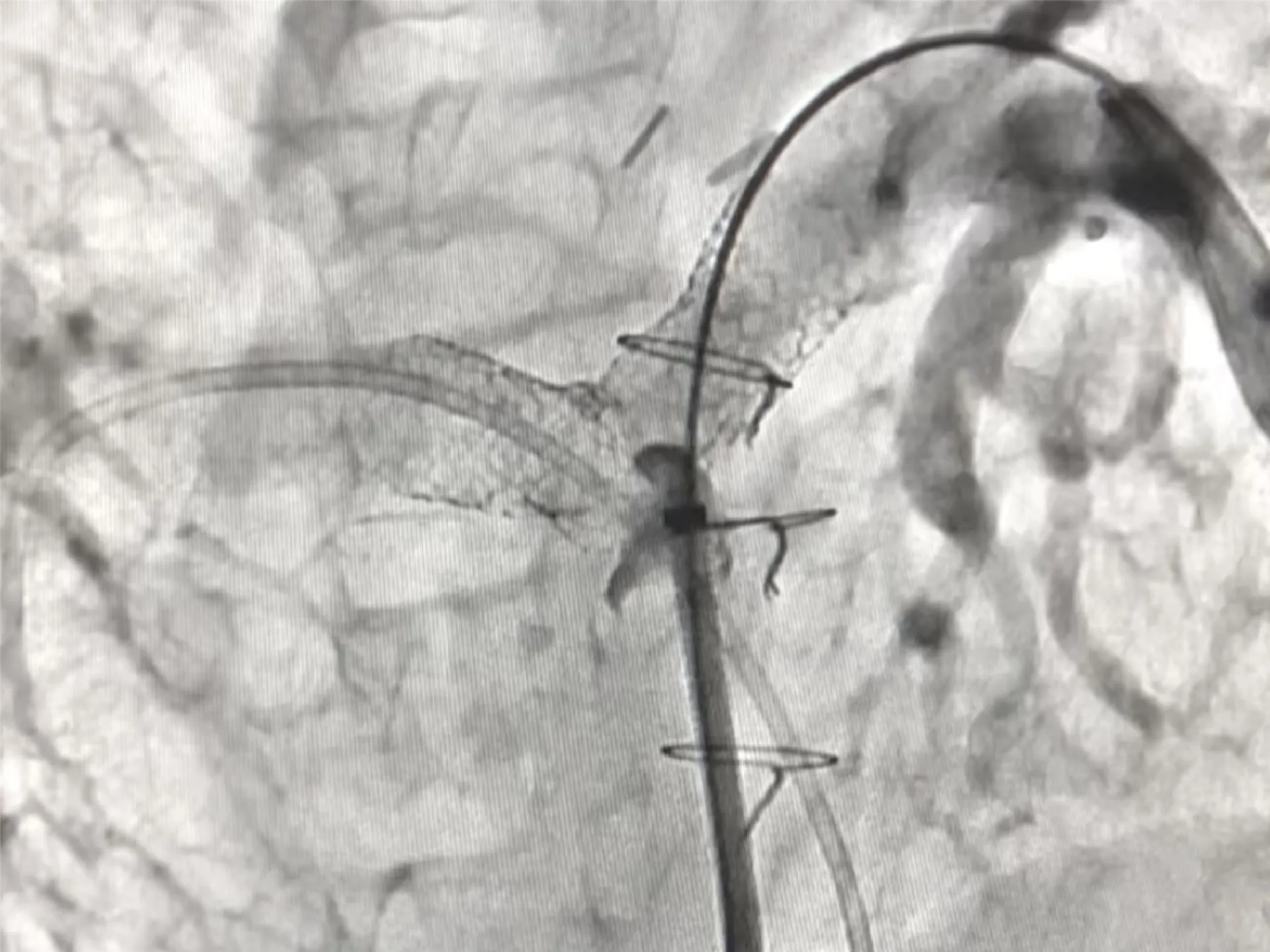 Pediatric Interventional Cardiology