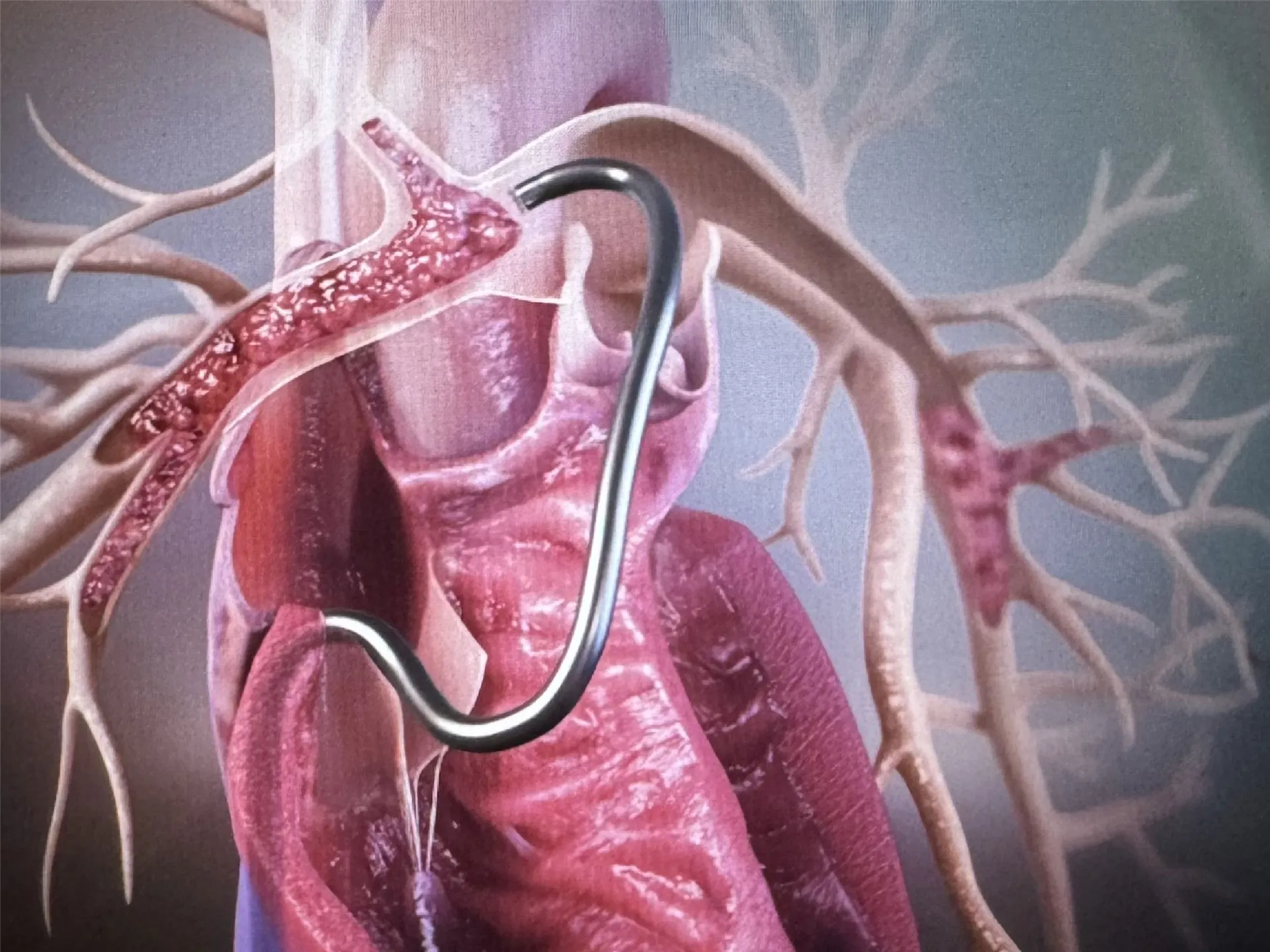 Girişimsel Kardiyoloji